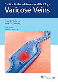 Varicose Veins - Felipe Collares - E-Book