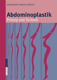 Abdominoplastik - Johannes-Franz Hönig - E-Book