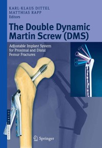 The Double Dynamic Martin Screw (DMS) -  - E-Book