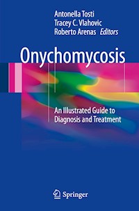 Onychomycosis -  - E-Book