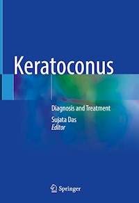 Keratoconus -  - E-Book