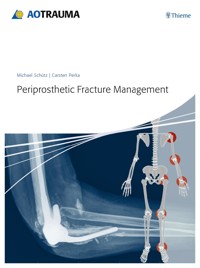 Periprosthetic Fracture Management - Michael Schütz - E-Book