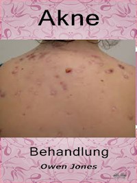 Akne-Behandlung - Owen Jones - E-Book