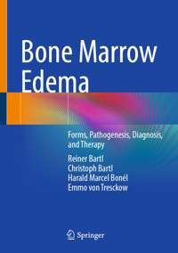 Bone Marrow Edema - Reiner Bartl - E-Book