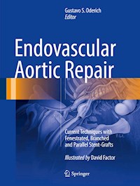 Endovascular Aortic Repair -  - E-Book