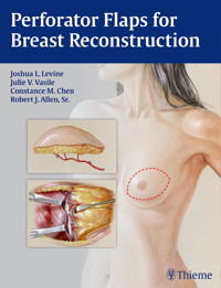 Perforator Flaps for Breast Reconstruction -  - E-Book