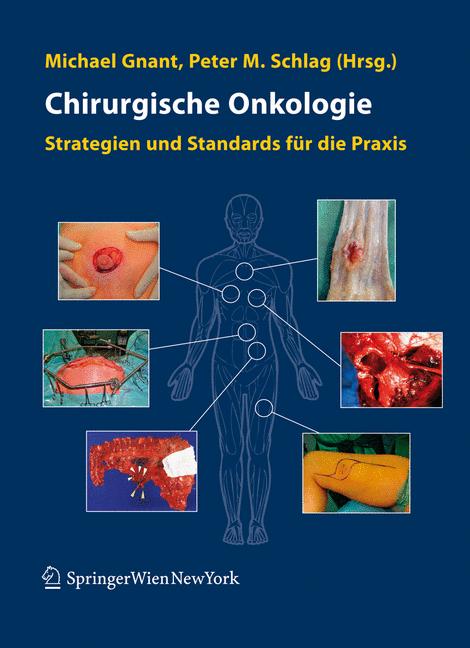 Chirurgische Onkologie - - E-Book
