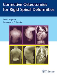 Corrective Osteotomies for Rigid Spinal Deformities -  - E-Book