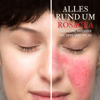 Alles Rund um Rosacea - Der kleine Ratgeber mit Tipps und Tricks - Raphael Kleine-Termeer - Hörbuch