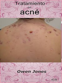 Tratamiento Del Acné - Owen Jones - E-Book