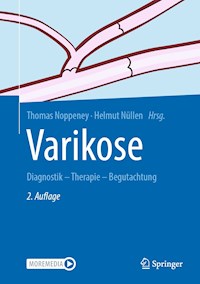 Varikose -  - E-Book