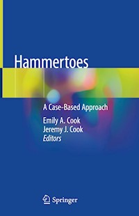 Hammertoes -  - E-Book