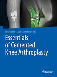 Essentials of Cemented Knee Arthroplasty -  - E-Book
