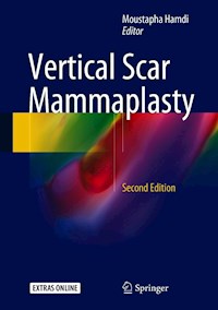 Vertical Scar Mammaplasty -  - E-Book