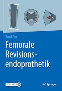 Femorale Revisionsendoprothetik - Bernd Fink - E-Book