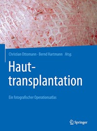 Hauttransplantation -  - E-Book