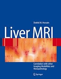 Liver MRI - Shahid M. Hussain - E-Book