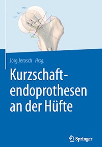 Kurzschaftendoprothesen an der Hüfte -  - E-Book