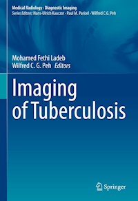 Imaging of Tuberculosis -  - E-Book